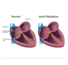 Atrial Fibrillation